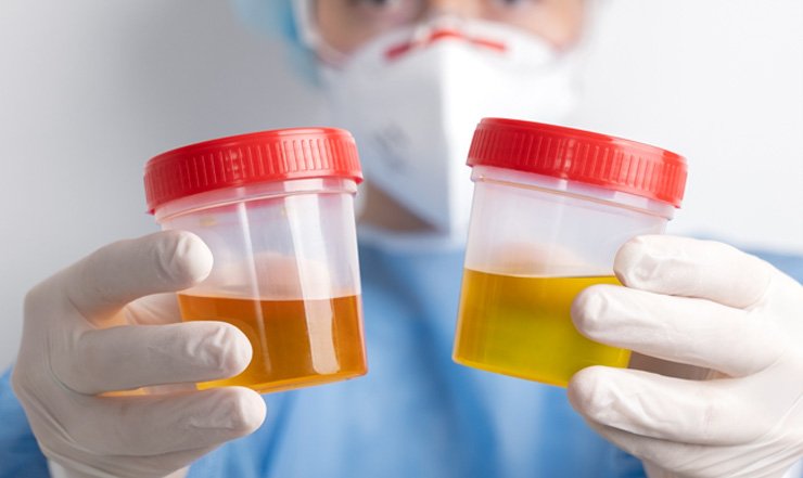 Decoding Dark Urine